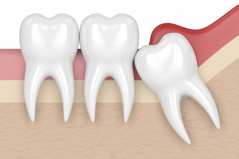 Wisdom Tooth Removal in Brighton